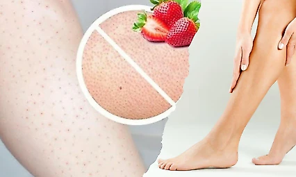 Çilek bacak neden olur, nasıl azalır? Dermatologdan bakım önerileri